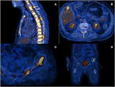 Case Report: Microangiopathic Hemolytic Anemia With Normal ADAMTS13 Activity